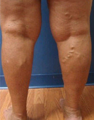 varicose veins