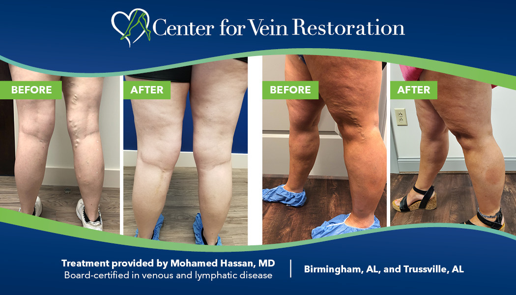 Center for Vein Restoration  ¿Debo usar medias de compresión después de mi  procedimiento venoso?