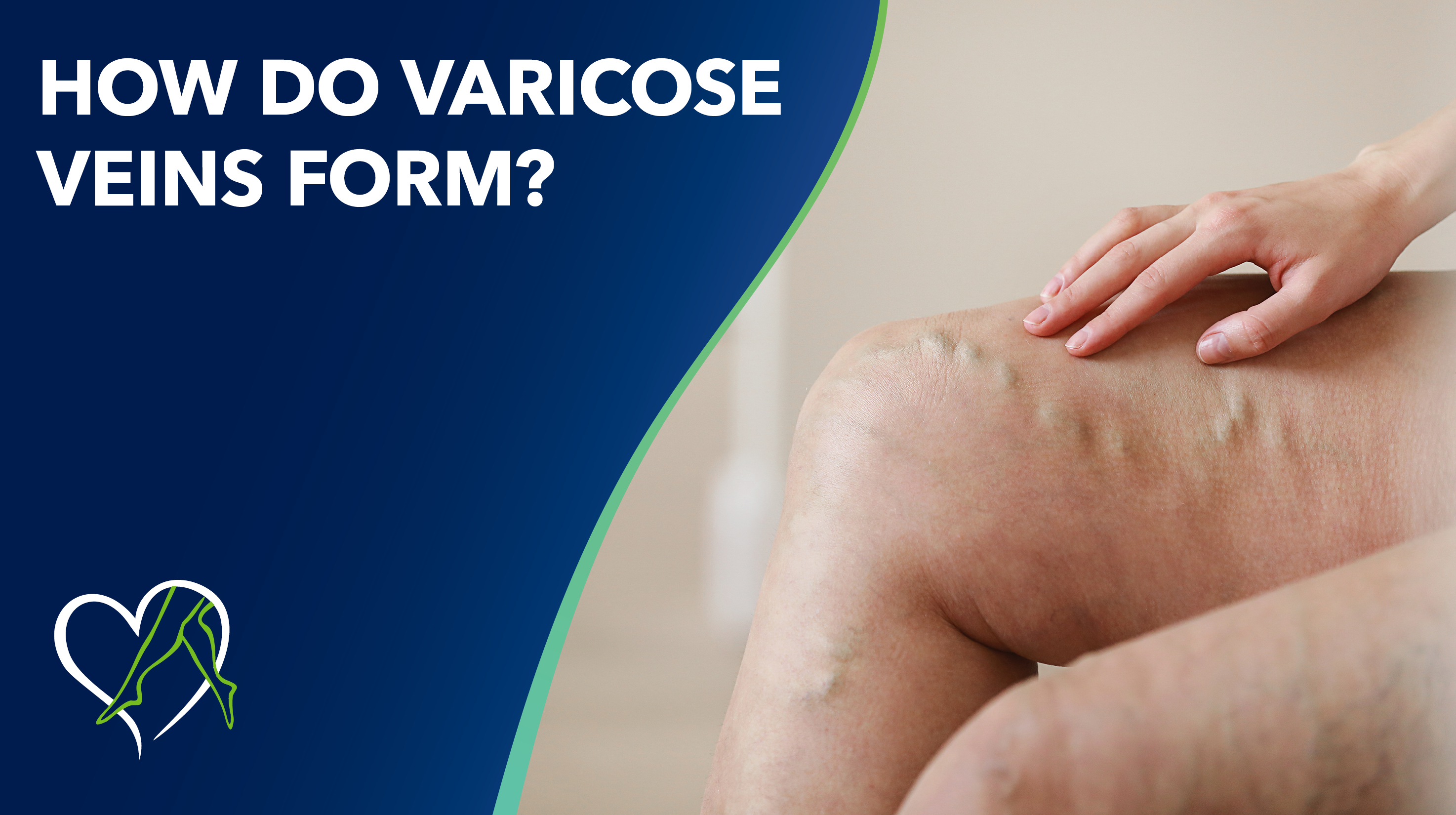 Blog Image How Do Varicose Veins Form THUMBNAIL