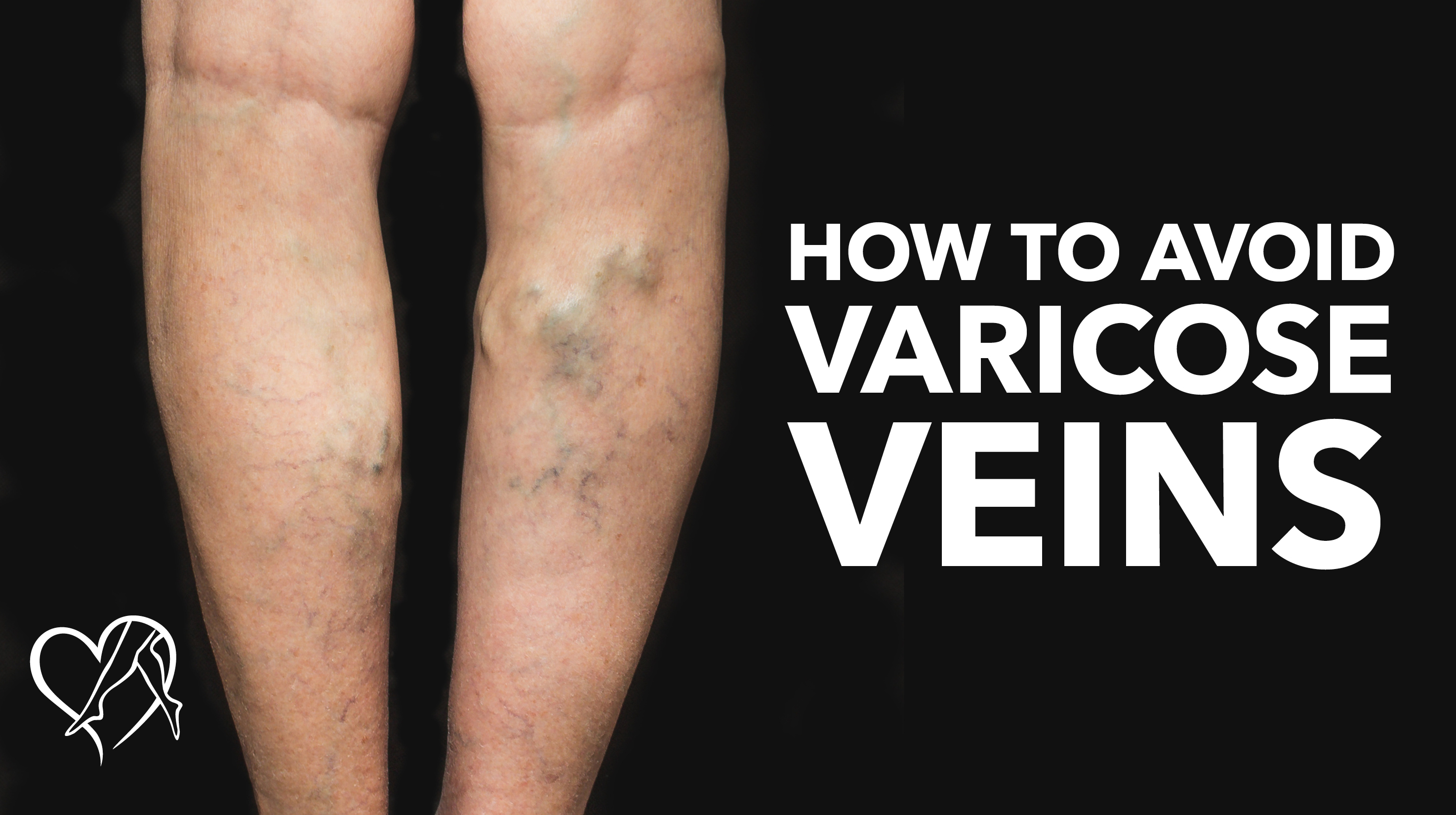 Blog Image Howto Avoid Varicose Veins Thumbnail