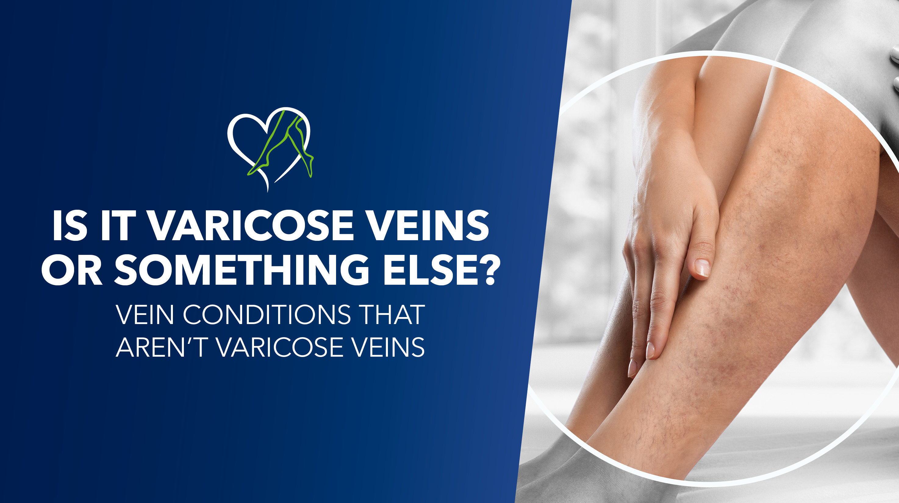 Blog Image Is It Varicose Veins Or Something Else Thumbnail