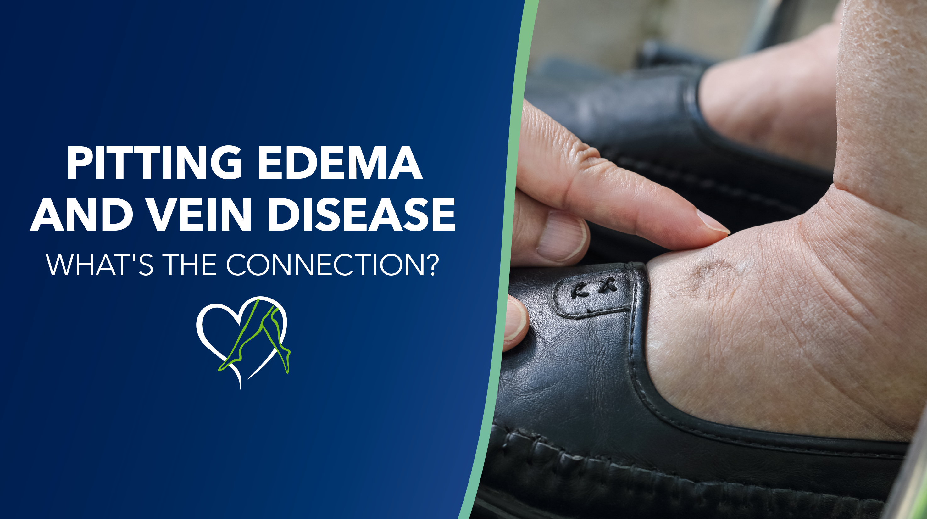 Blog Image Pitting Edema And Vein Disease Thumbnail