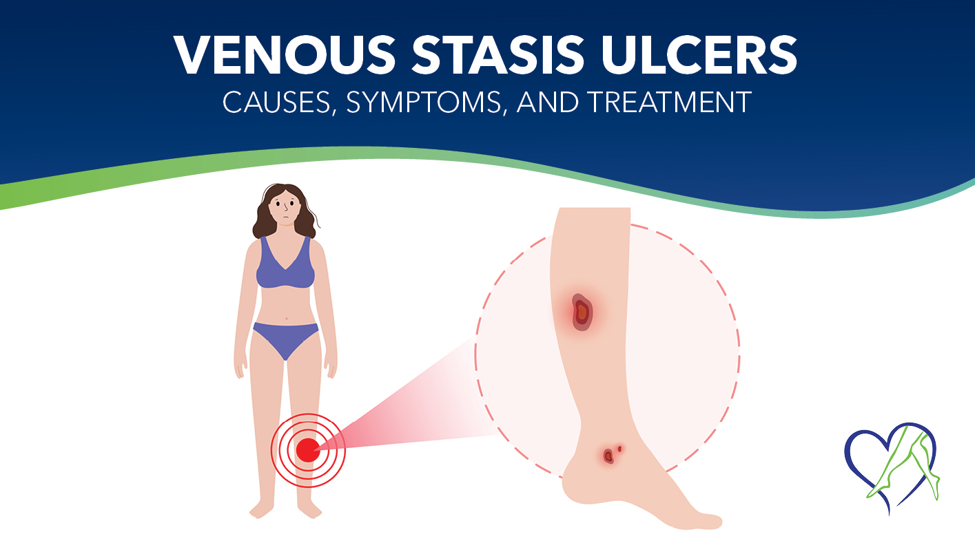 Blog Image Venous Stasis Ulcers THUMBNAIL