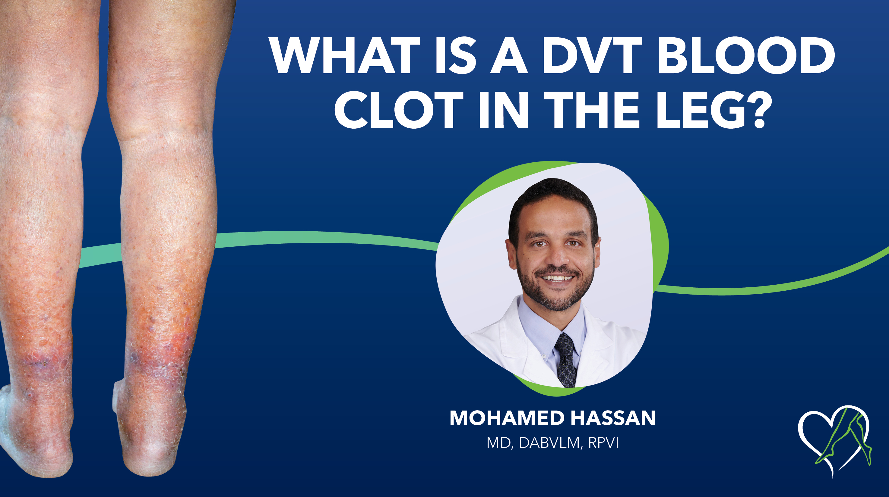 Blog Dr Hassasn What Is a DVT Blood Clot Thumbnail