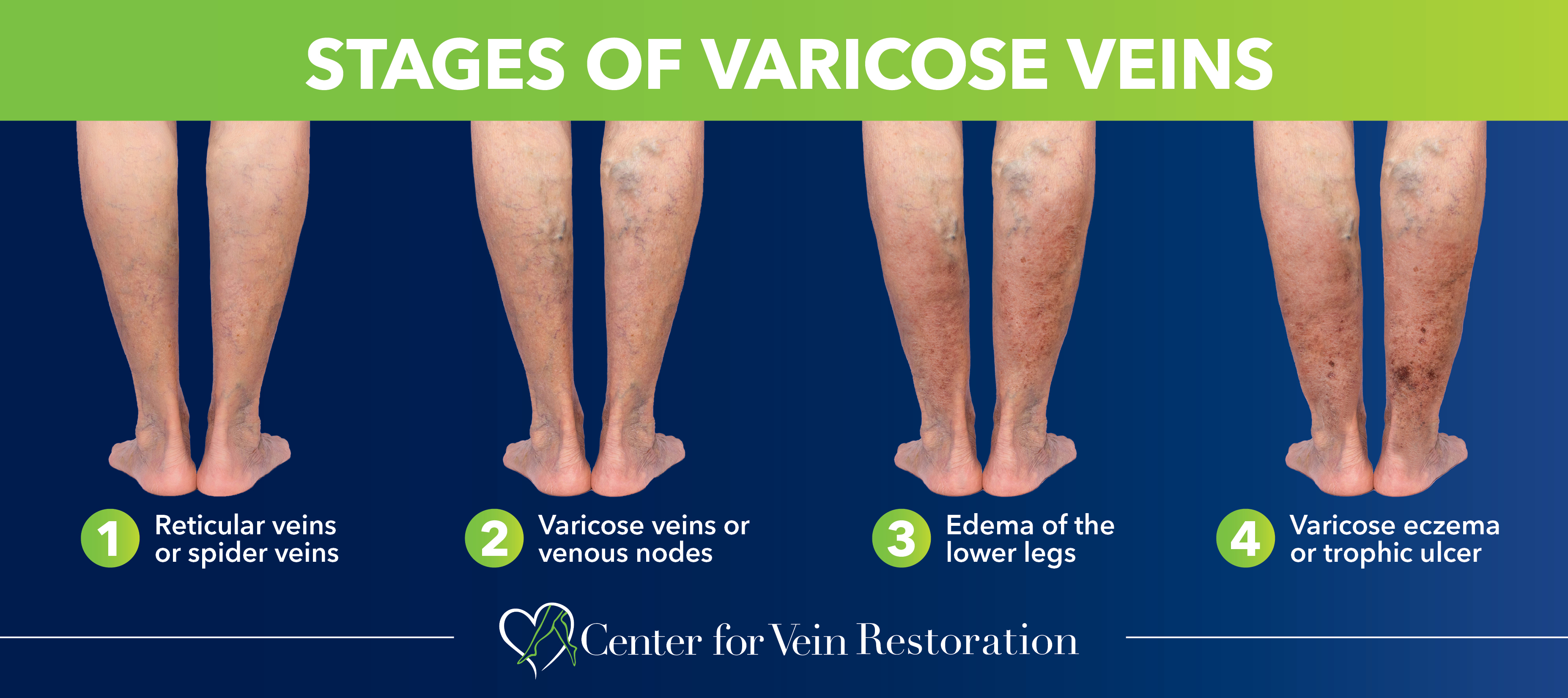 What are the Stages of Varicose Veins?