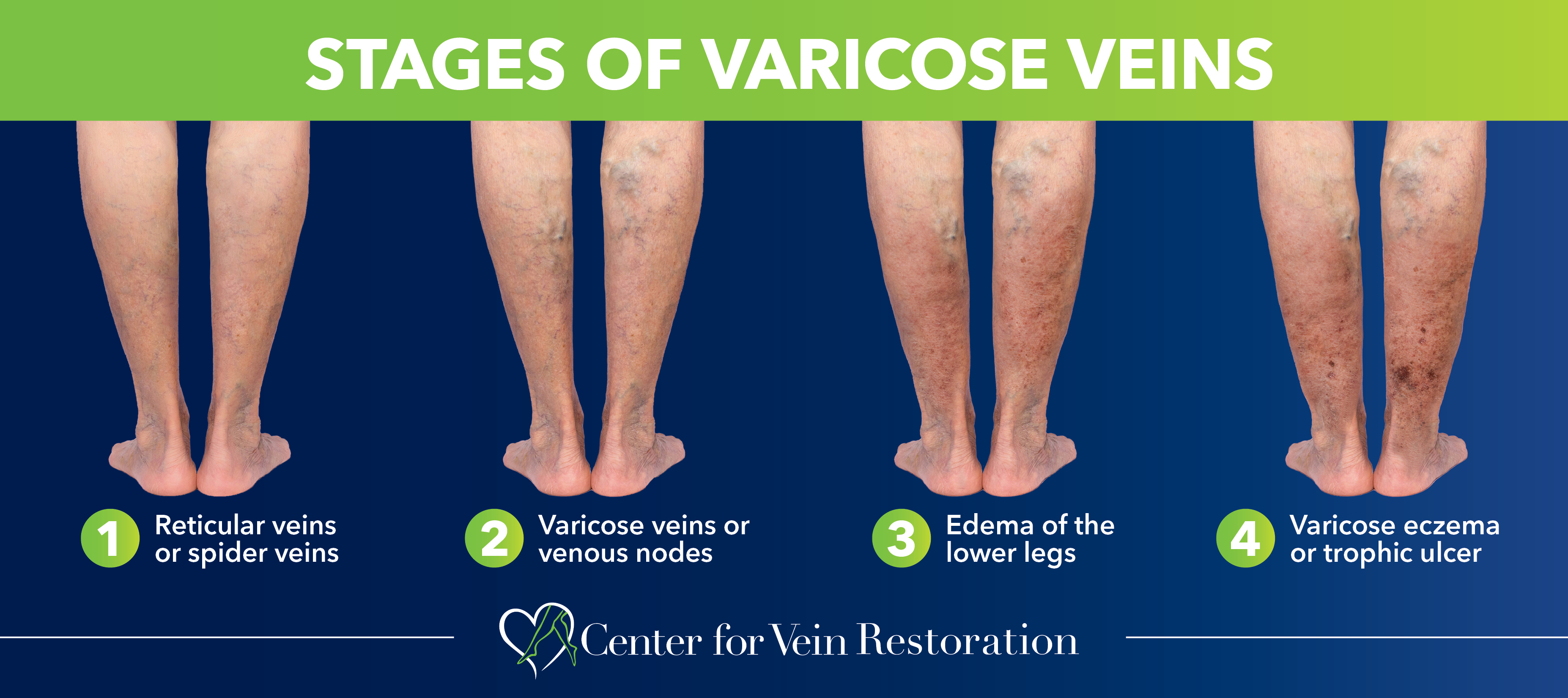 Occupations Most at Risk for Varicose Veins - How to Help