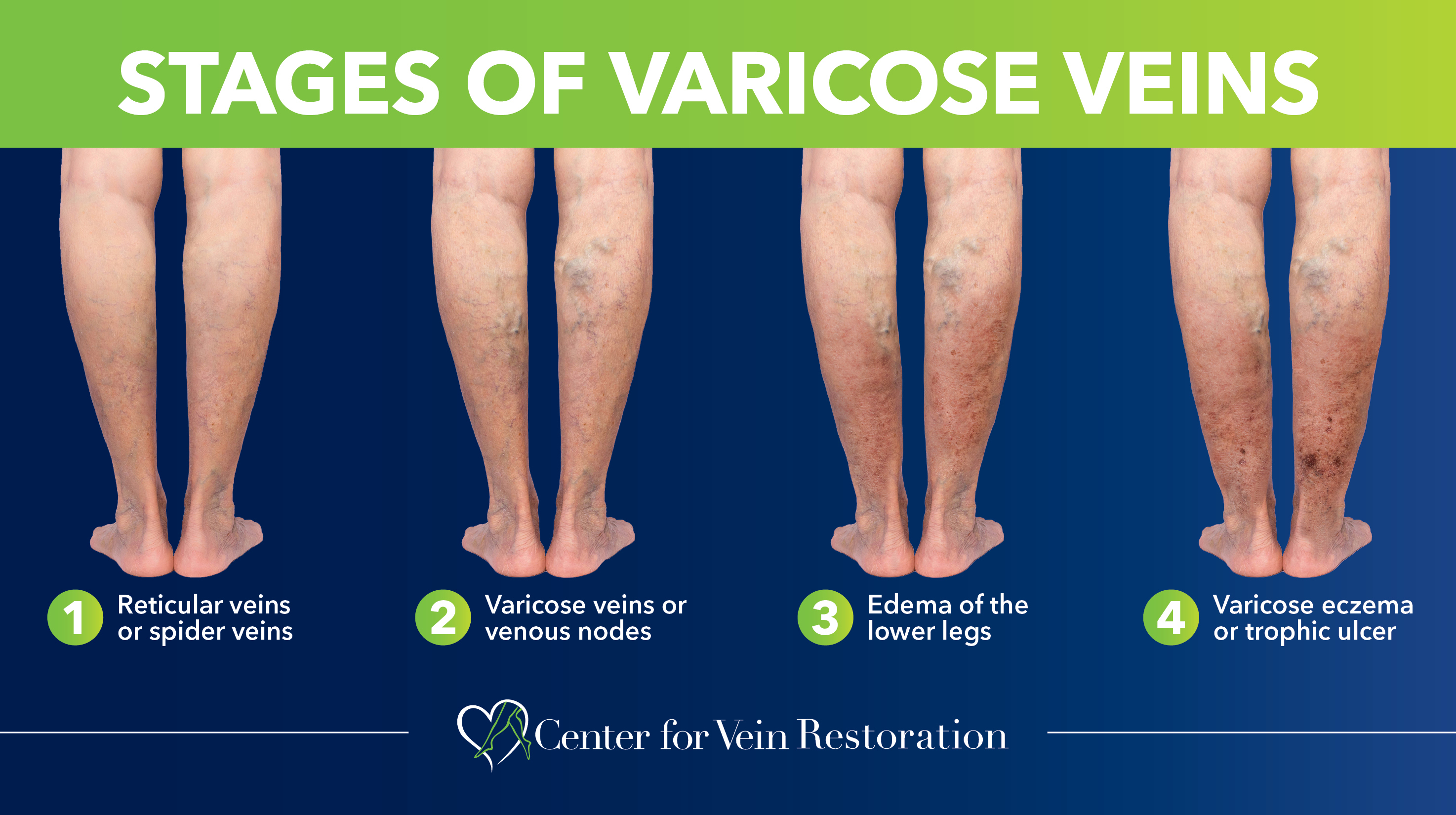 Blog Stages Of Varicose Veins Thumbnail