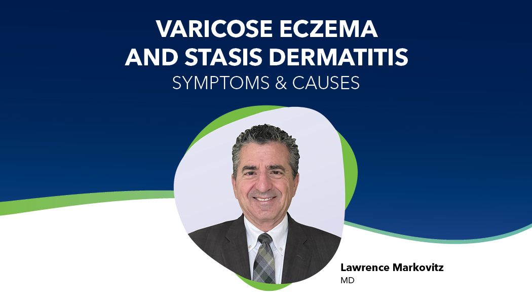 Blog Varicose Eczema Stasis Dermatitis