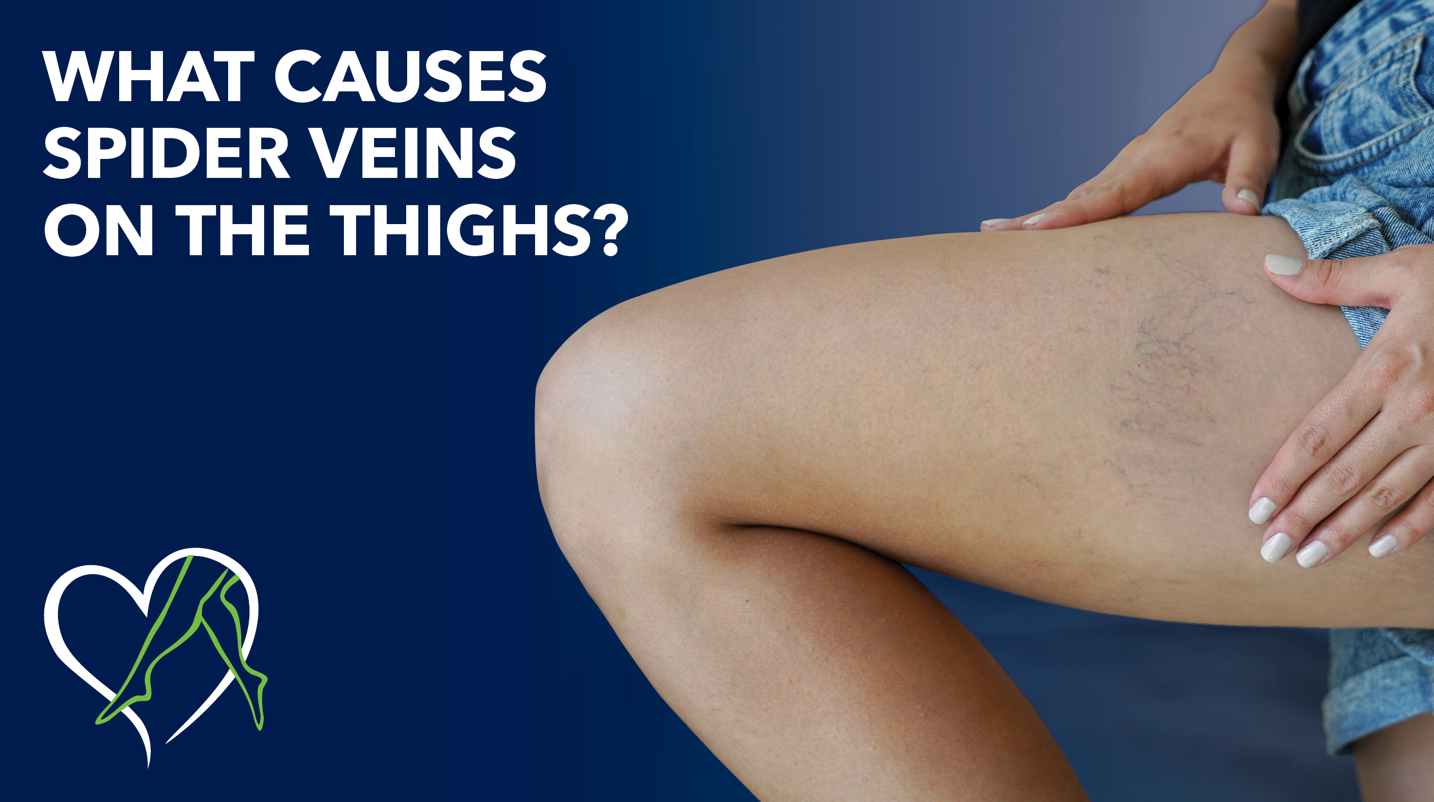 Blog What Causes Spider Veins On Thighs Thumbnail