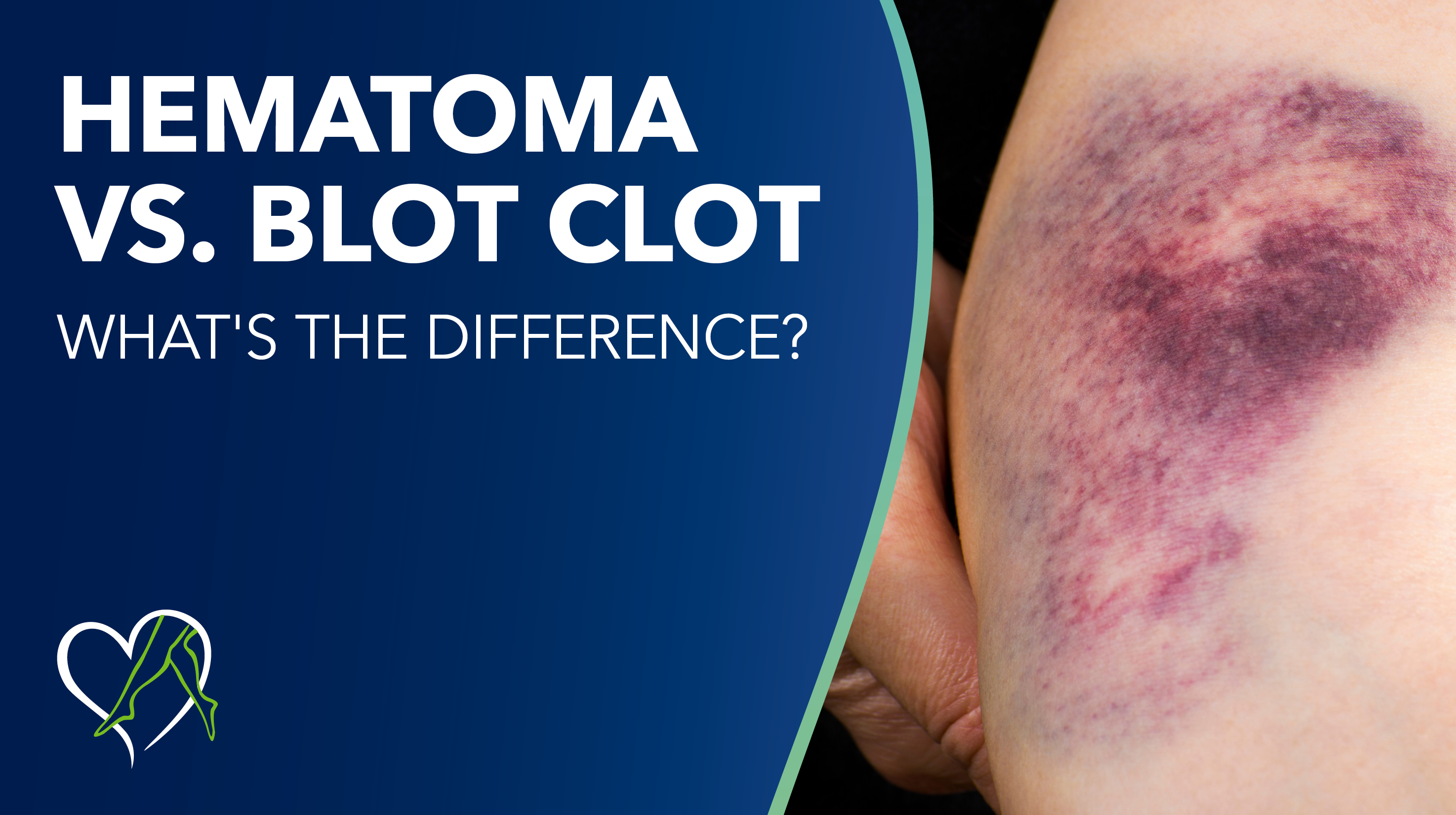 Hematoma Vs Blood Clot Blog Thumbnail