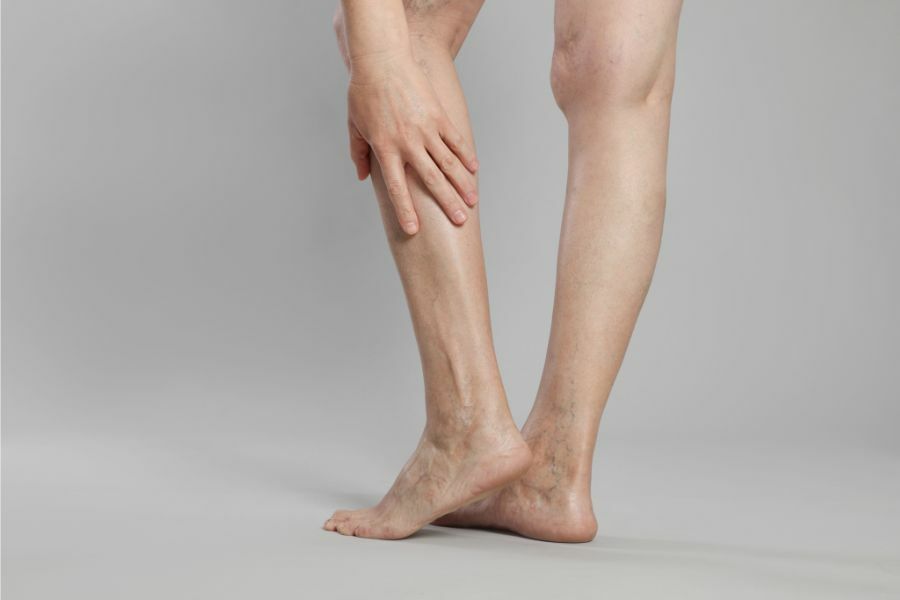Is It Worth Getting Varicose Veins Removed