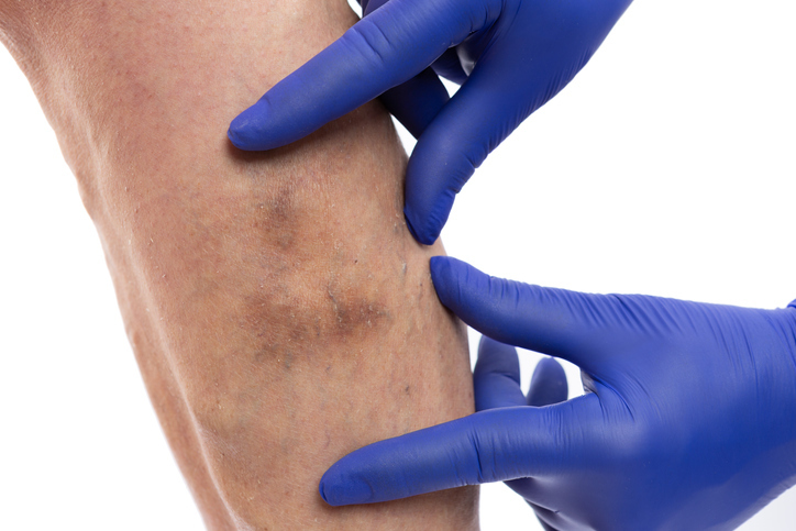 Leg with skin discolor