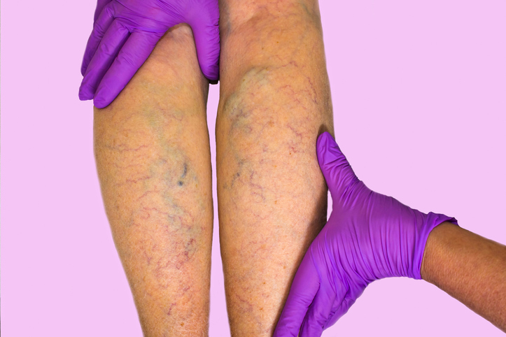 Legs with Chronic Venous Insufficiency