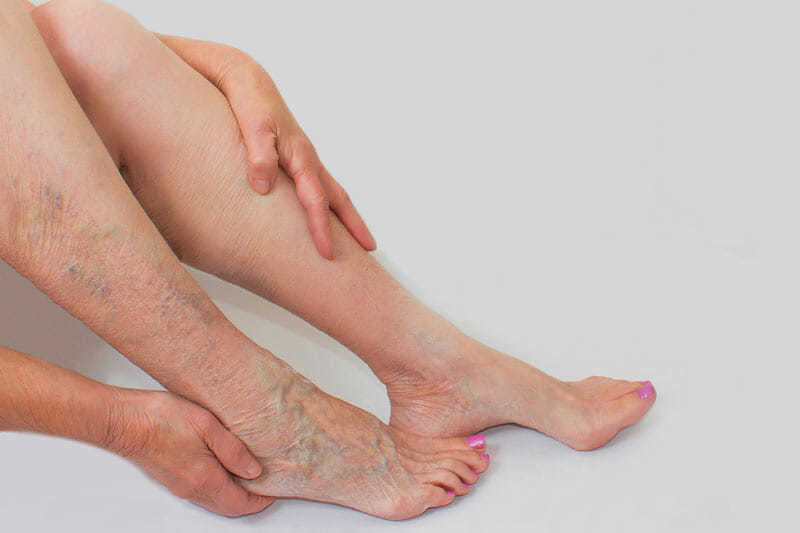 How to Treat Varicose Veins Without Surgery?