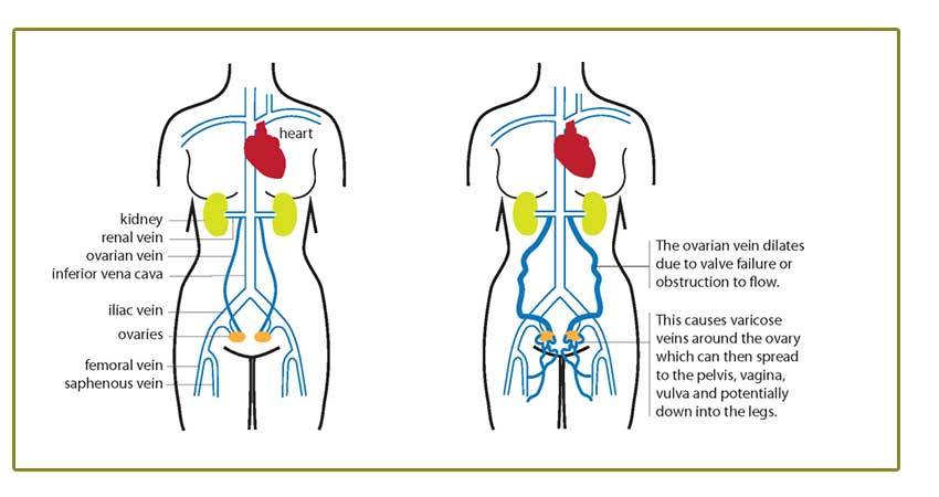 Pelvic Venous Syndromes