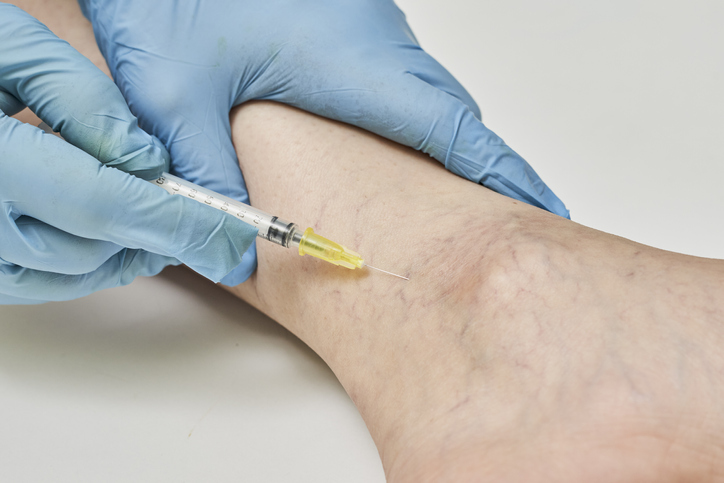 Sclerotherapy in ankle