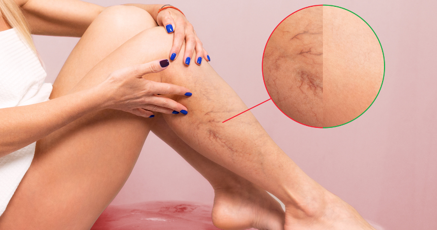 Spider Vein Free Legs Can Be Yours