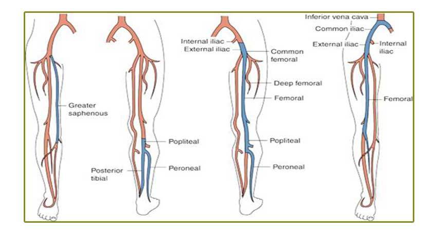 Superficial Thrombophlebitis