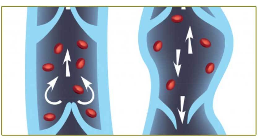 Venous Reflux Disease