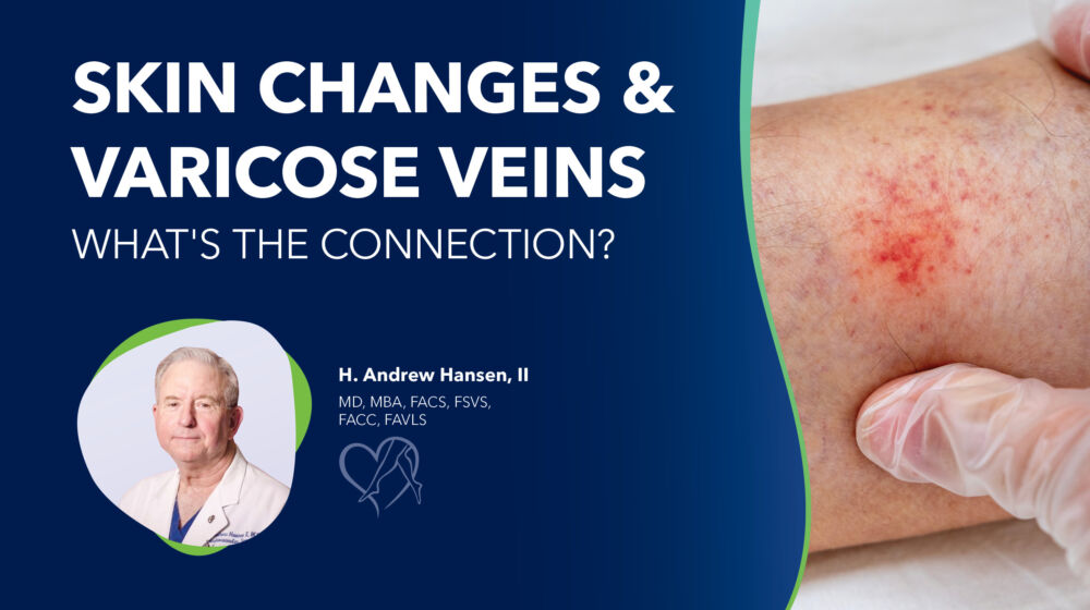 Blog Image Skin Changes And Varicose Veins Thumbnail