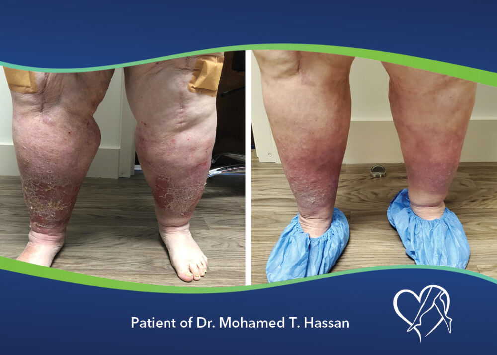 CVR Dr Hassan Cellulitis 072122