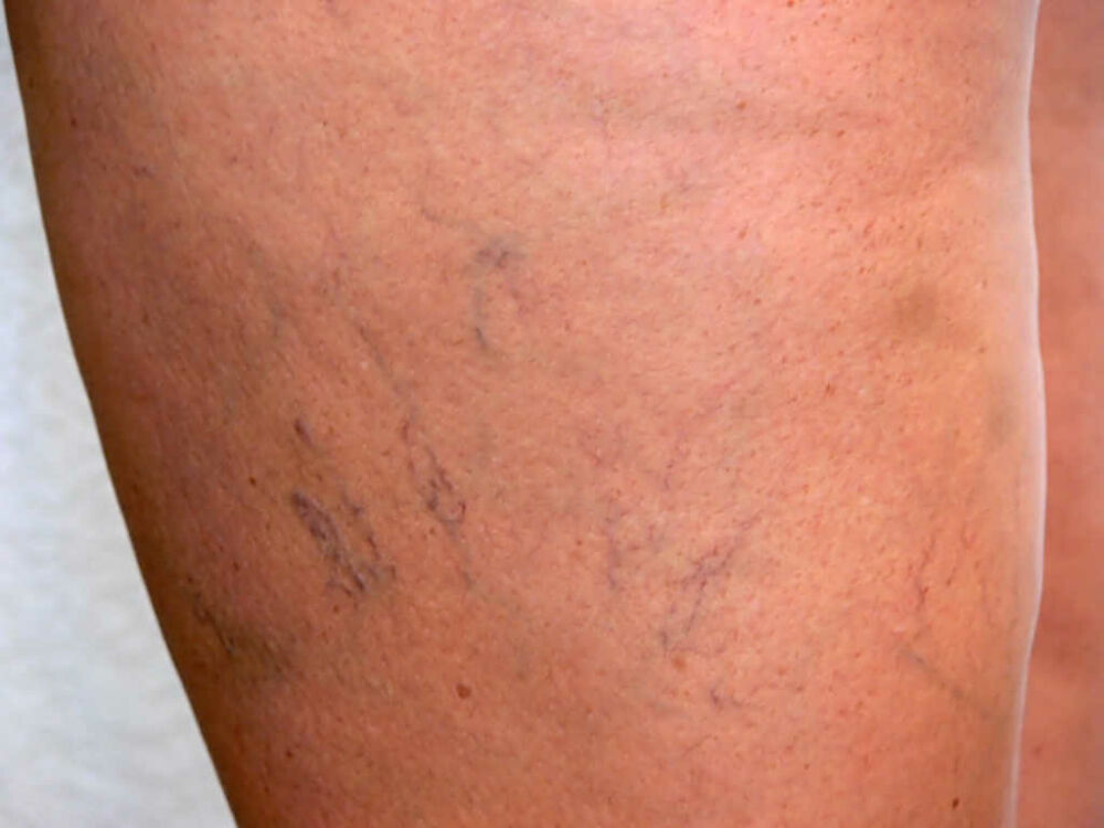 Spider Veins