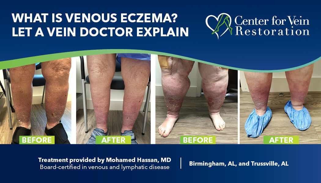 Blog Venous Eczema Dr Hassan