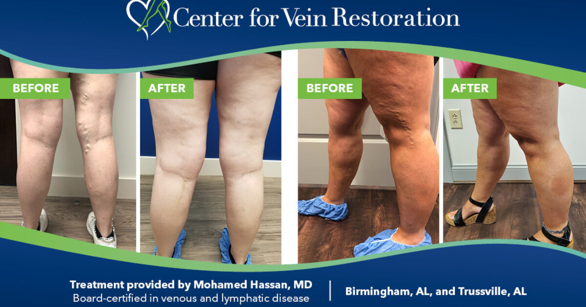 How to Prevent Recurring Varicose Veins