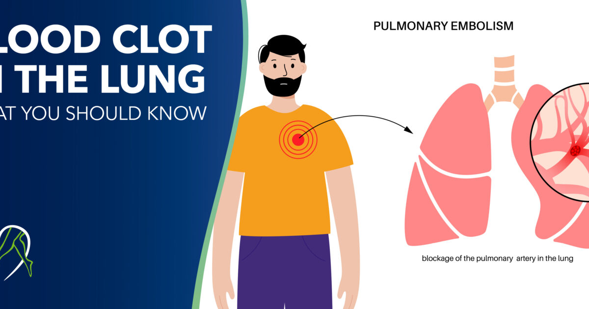Blood Clot in the Lung What You Should Know