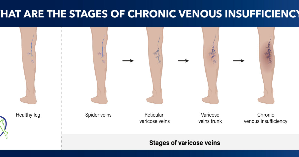 Chronic venous insufficiency stages explained provascularmd
