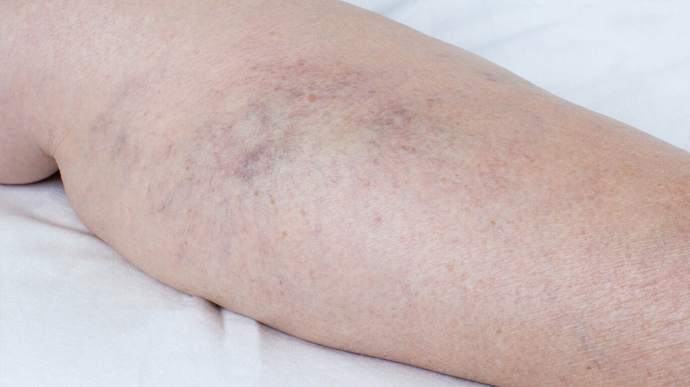 Should I See a Vein Specialist for Superficial Thrombophlebitis