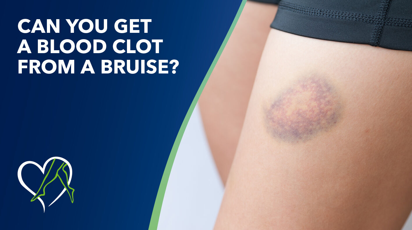 Blog Can You Get Blood Clot From Bruise Thumbnail