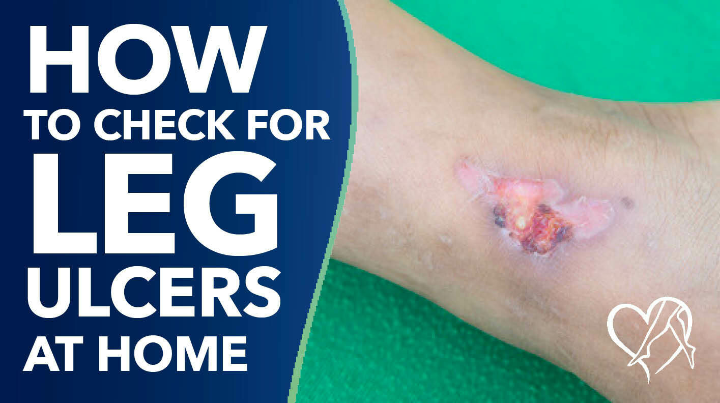 Blog How To Check For Leg Ulcers At Home Thumbanail