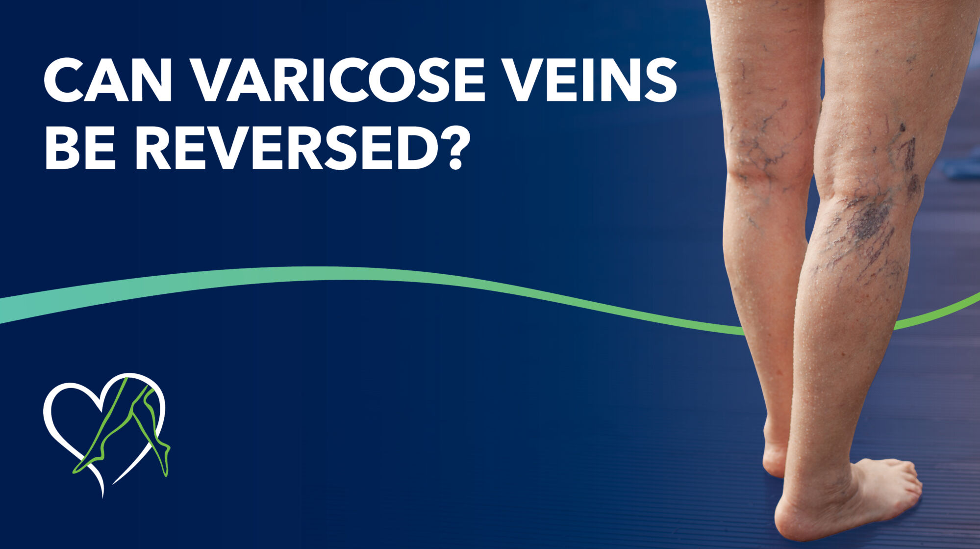 Blog Can Varicose Veins Be Reversed Thumbnail