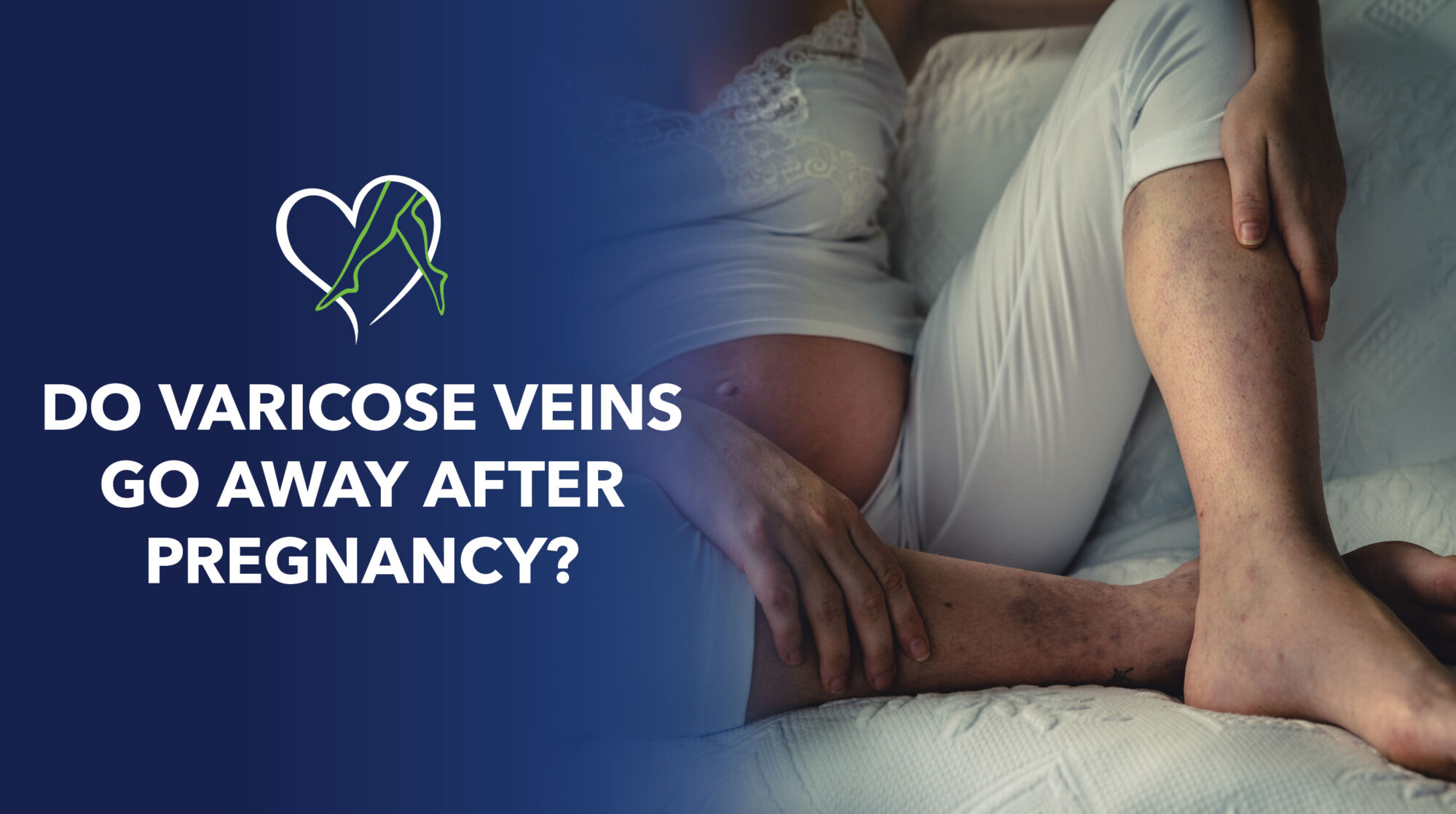 Blog Do Varicose Veins Go Away After Pregnancy Thumbnail