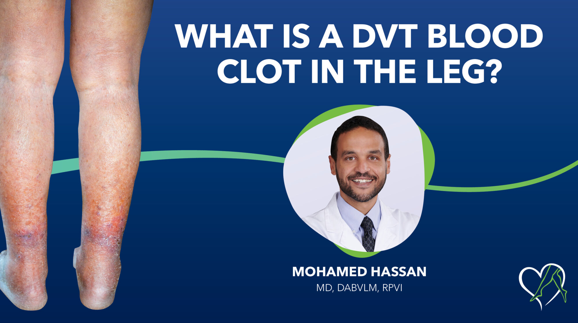 Blog Dr Hassasn What Is a DVT Blood Clot Thumbnail