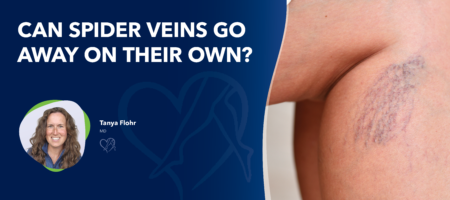 Blog Image Can Spider Veins Go Awayon Their Own