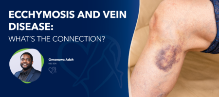 Blog Image Ecchymosisand Vein Disease