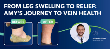 Blog Image Pt Story From Leg Swelling to Relief Amys Journey to Vein Health