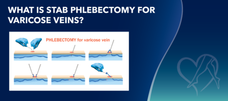 Blog Image Whatis Stab Phlebectomyfor Varicose Veins