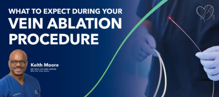 Blog Image Whatto Expect Vein Ablation