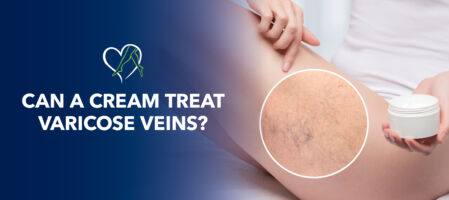 Blog Can Cream Treat Varicose Veins