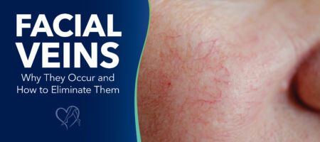 Blog Facial Veins