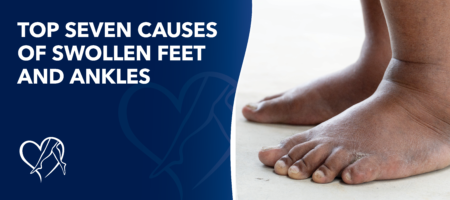 Blog Top Seven Causesof Swollen Feetand Ankles