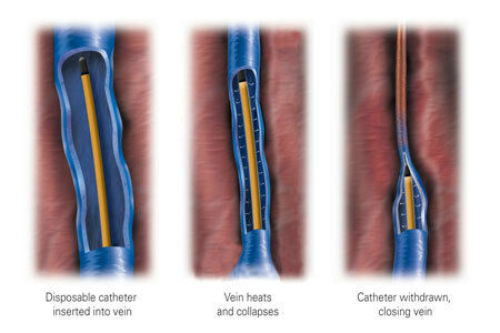 Closure Procedure Illustration 1