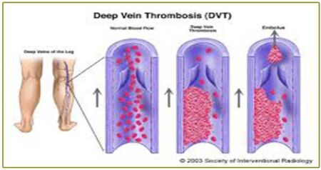 TVP Trombosis venosa profunda