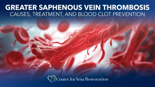 Blog Image Greater Saphenous Vein Thrombosis Thumbnail