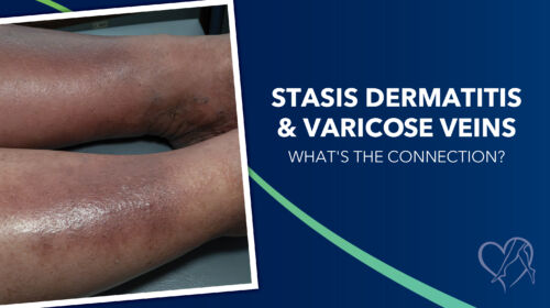 Blog Image Statis Dermatitis Thumbnail