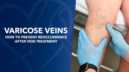 Blog Image Varicose Veins Howto Prevent Reoccurrence After Vein Treatment Thumbnail