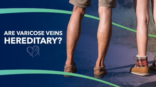 Blog Image Are Varicose Veins Hereditary Thumbnail